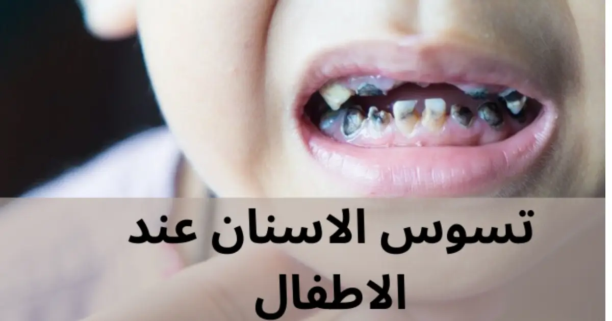 تسوس الاسنان عند الاطفال
