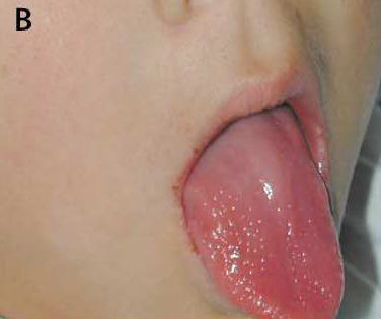 مظهر-لسان-التوت-مرض-كاواساكي