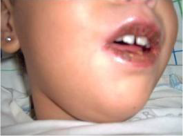 التهاب-الشفتين-في-مرض-كاواساكي