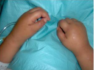 انتفاخ-في-اليدين-مرض-كاواساكي