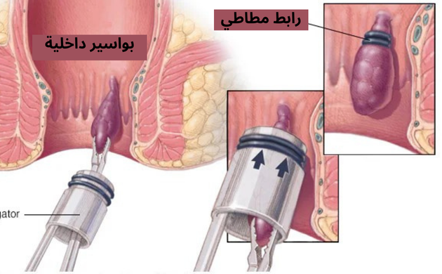 علاج البواسير الداخلية بتقنية ربط البواسير المرن